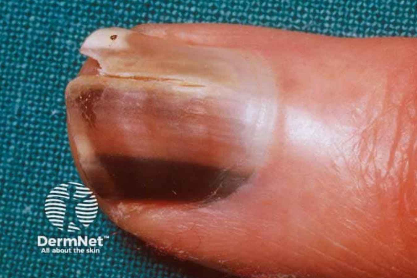 Advanced melanoma of the toenail with extensive dark pigmentation beneath the nail.