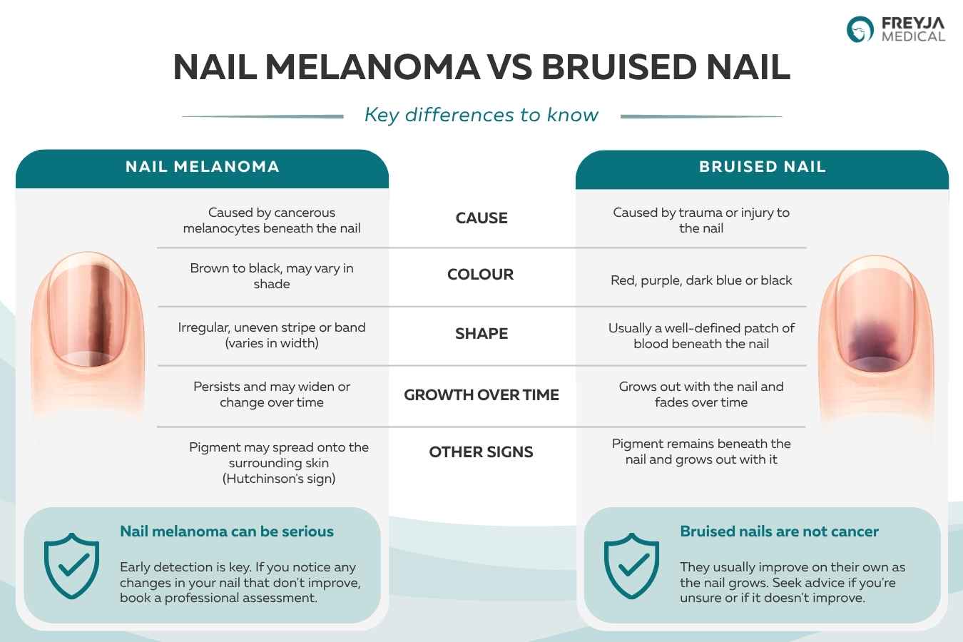 Comparison infographic showing the differences between nail melanoma and a bruised nail, including causes, appearance, growth over time and warning signs such as Hutchinson's sign.