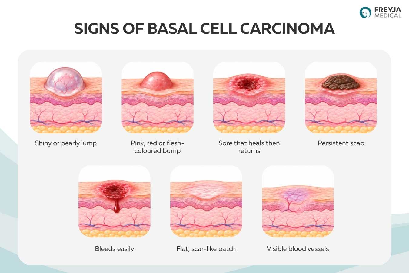 Diagram showing signs of basal cell carcinoma, including a pearly lump, non-healing sore, persistent scab, bleeding lesion and visible blood vessels.
