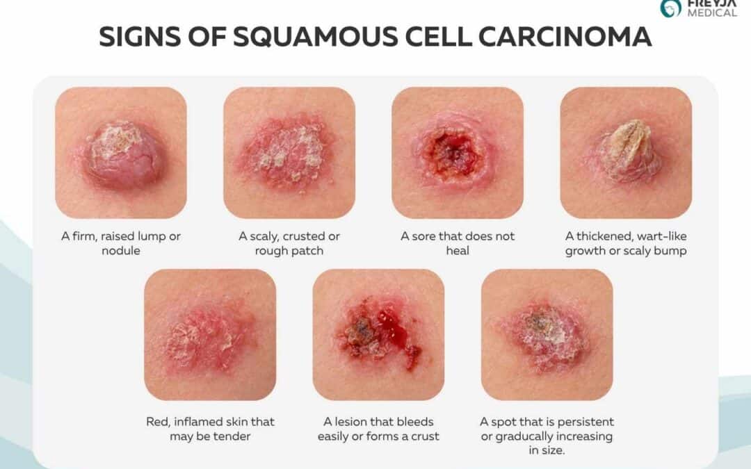 Types of Skin Cancer With Photos: What to Look for