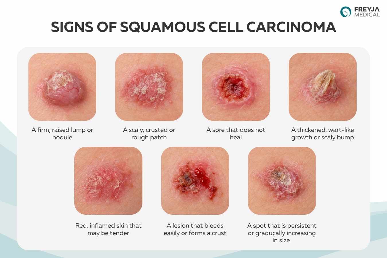 Diagram showing signs of squamous cell carcinoma, including raised lumps, scaly patches, non-healing sores, bleeding lesions and persistent skin changes.