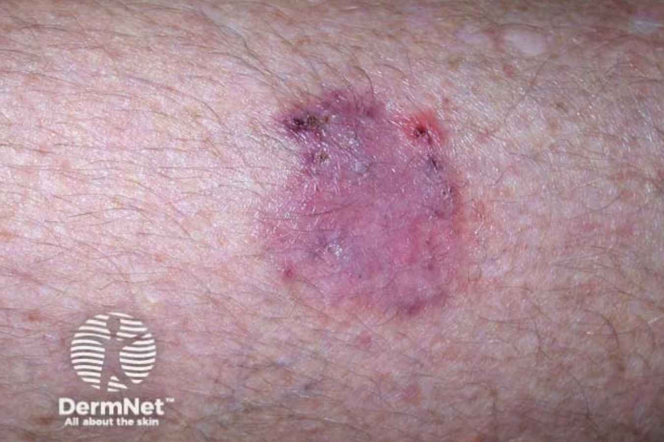 Bowen’s disease appearing as a pink-red patch with areas of crusting on the skin.