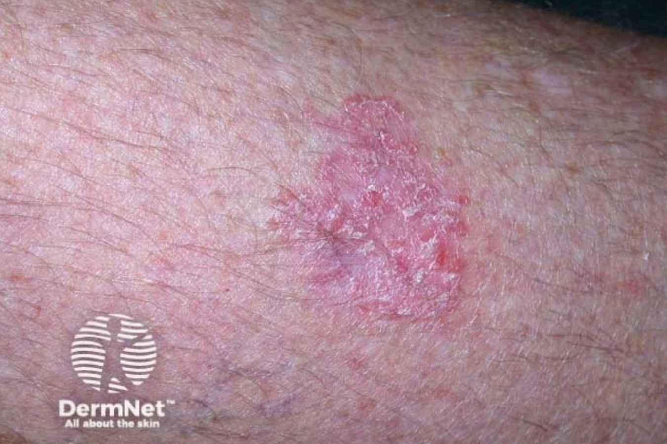 Bowen’s disease appearing as a red, scaly patch of skin.