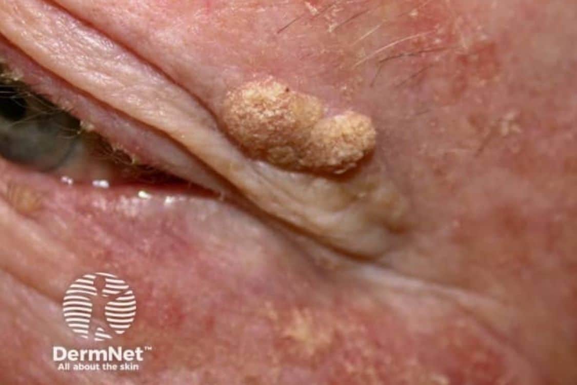 Seborrhoeic keratosis on the skin beside the eye