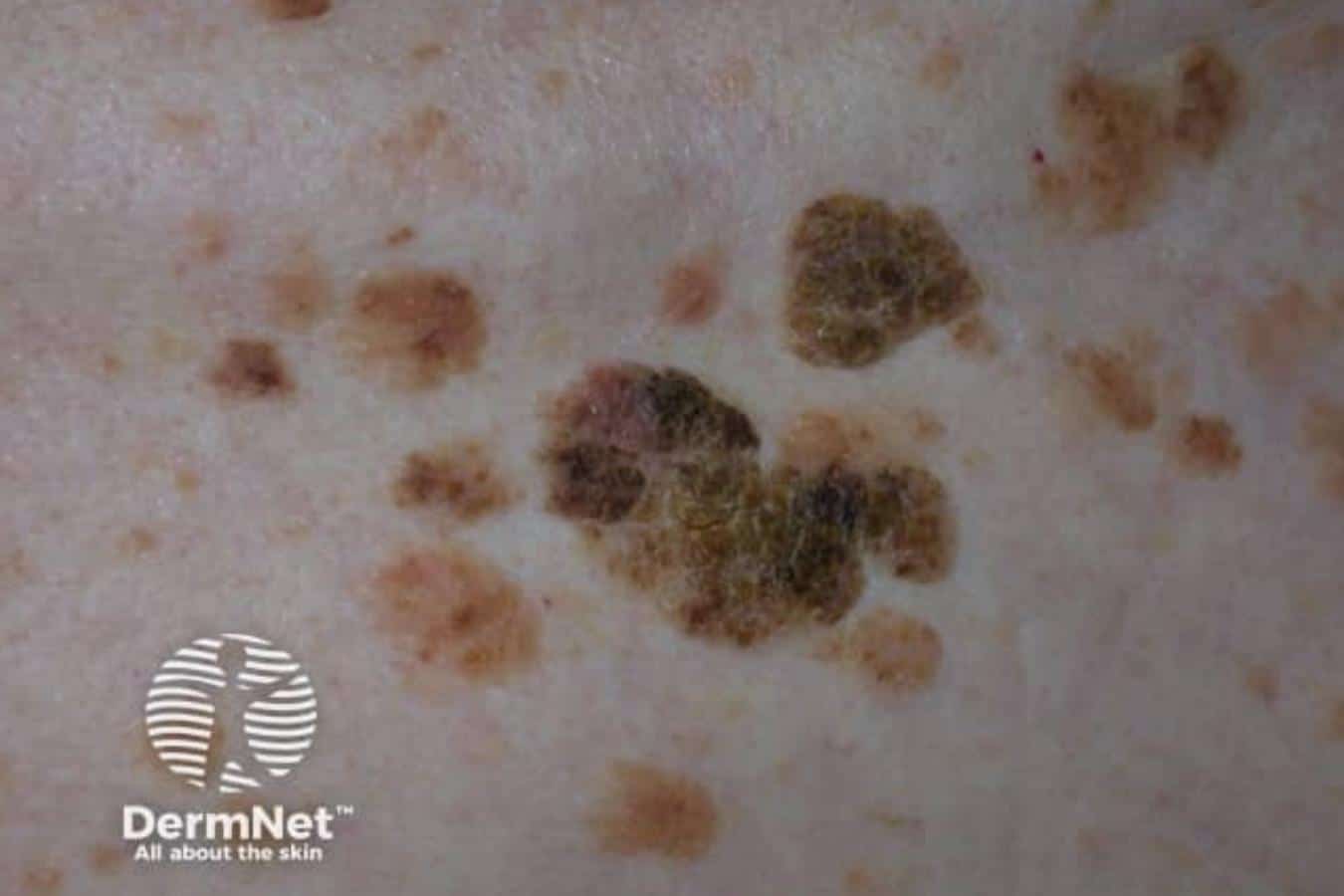 Multiple brown seborrhoeic keratoses on the skin