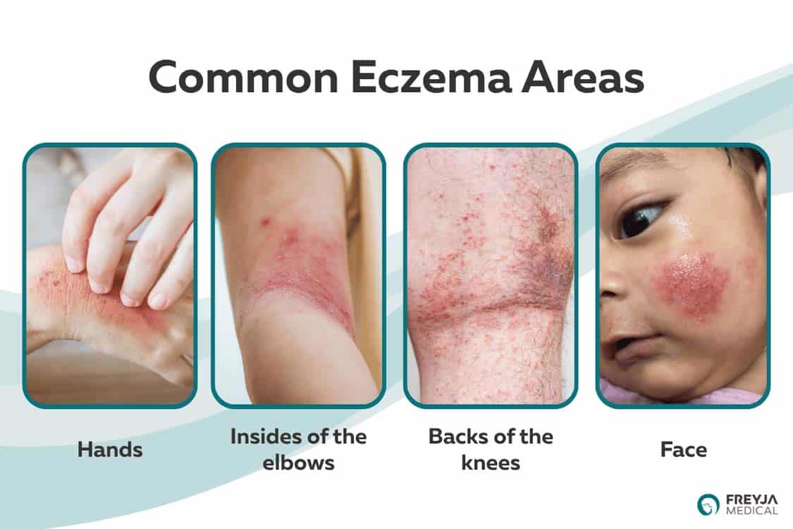 Diagram showing common eczema areas, including the hands, insides of the elbows, backs of the knees and face.