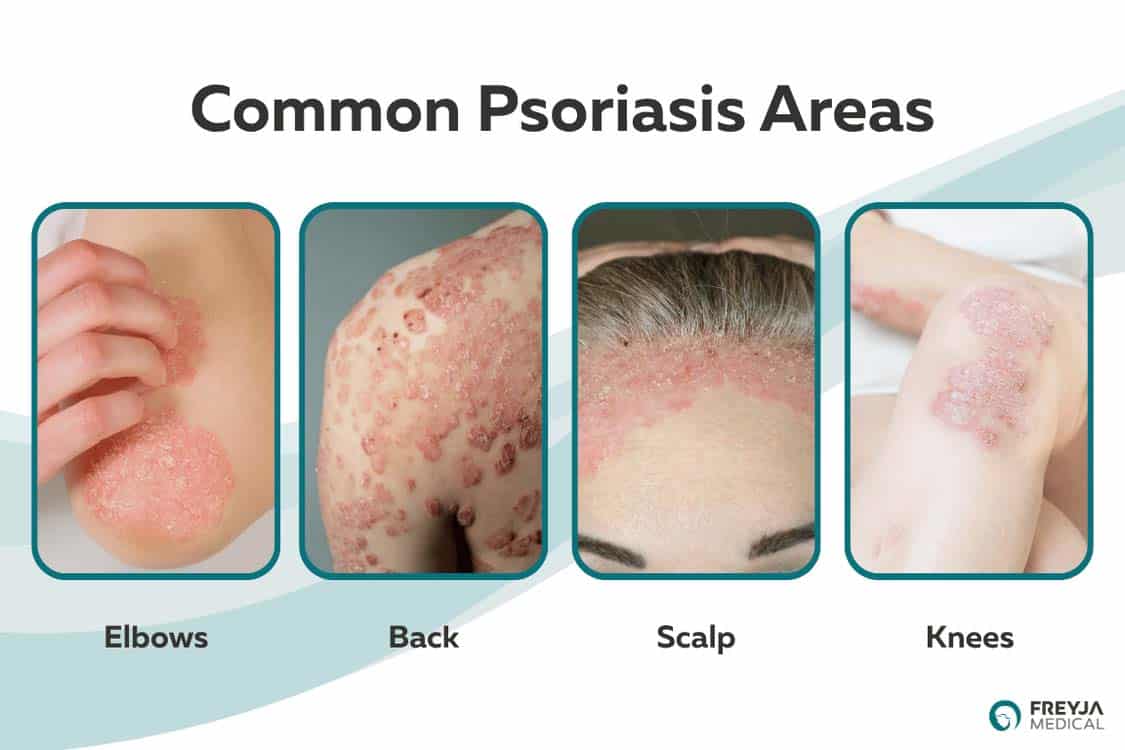 Diagram showing common psoriasis areas, including the elbows, back, scalp and knees.