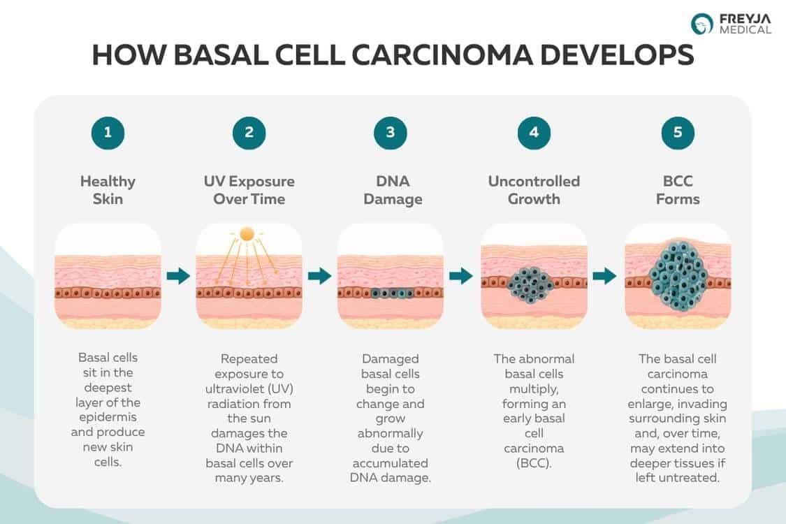 Diagram showing how basal cell carcinoma develops, from healthy basal cells through UV-related DNA damage and uncontrolled cell growth to the formation of BCC.
