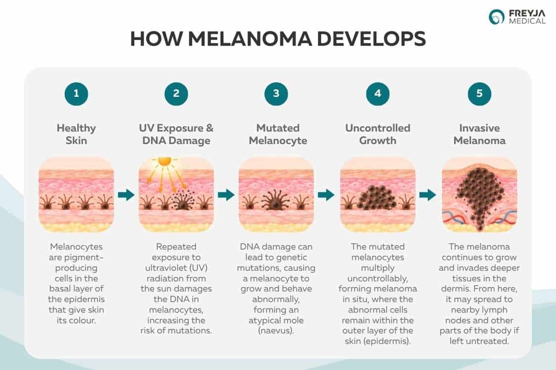 Diagram showing how melanoma develops, from healthy melanocytes through UV-related DNA damage and abnormal cell growth to invasive melanoma.