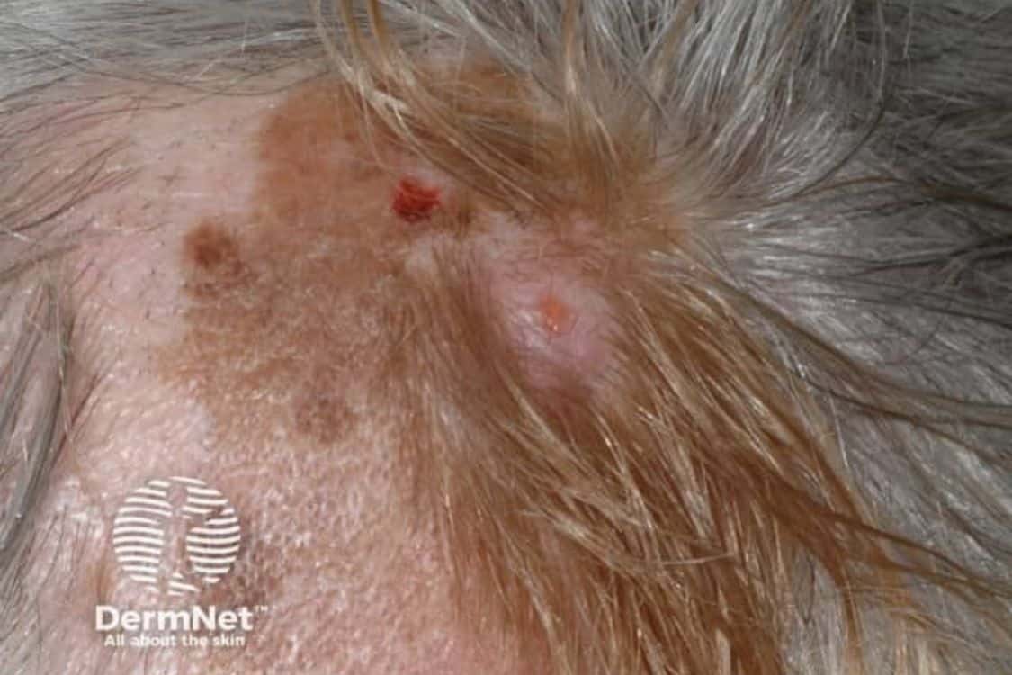Melanoma on the scalp near the hairline, showing an irregular pigmented lesion with areas of redness.