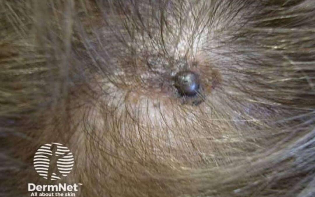 Dark melanoma on the scalp partially concealed by surrounding hair.