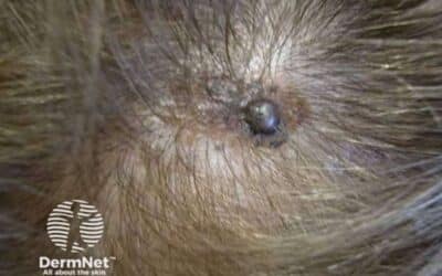 Melanoma on the Scalp: Symptoms and Treatment