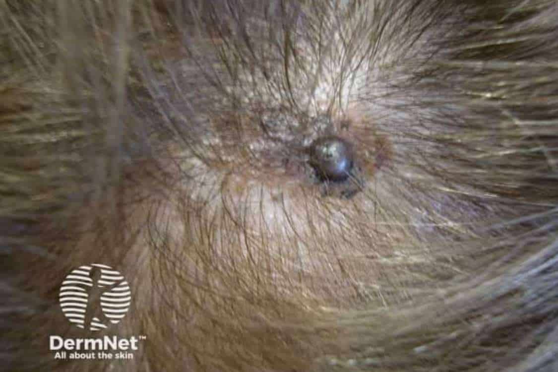 Dark melanoma on the scalp partially concealed by surrounding hair.