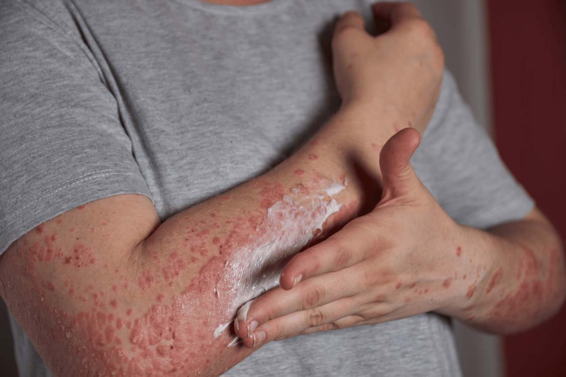 Person applying a topical cream to an area of psoriasis on their arm.