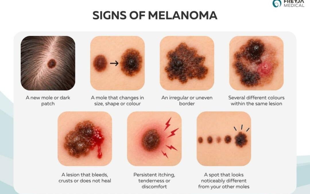 Melanoma Skin Cancer Early Stage