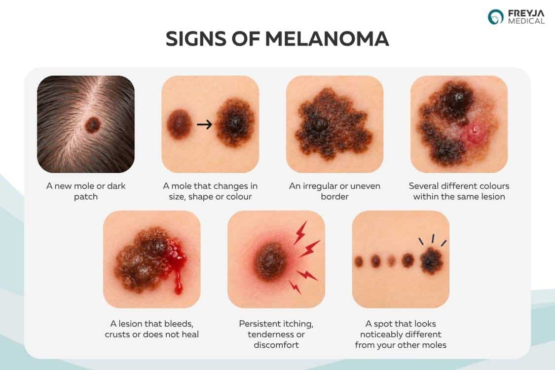 Signs of melanoma infographic showing seven warning signs, including a new or changing mole, irregular borders, multiple colours, bleeding, itching and a mole that looks different from others.