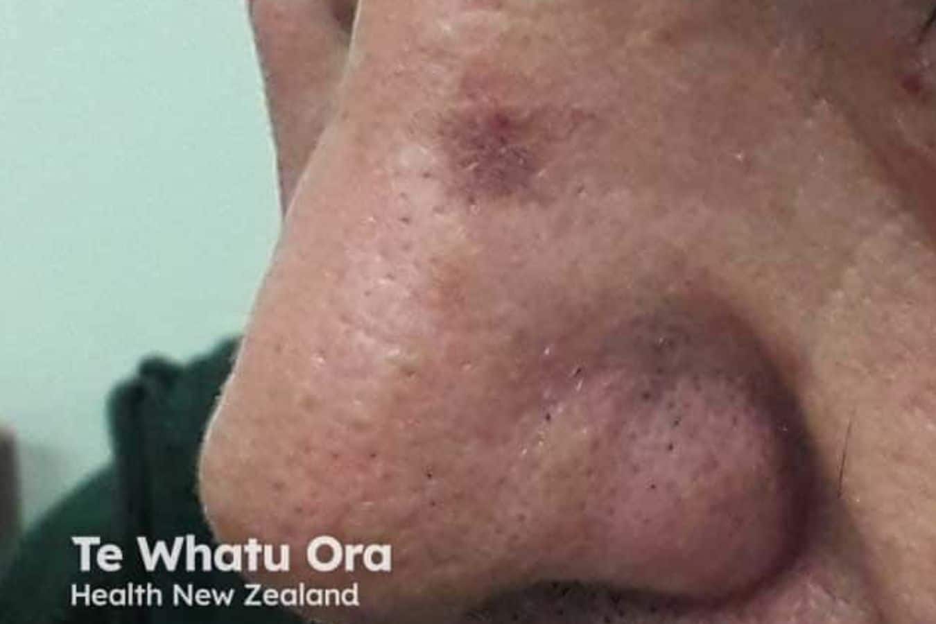 Close-up of solar keratosis (actinic keratosis) on the nose, showing a reddish-brown patch of sun-damaged skin.