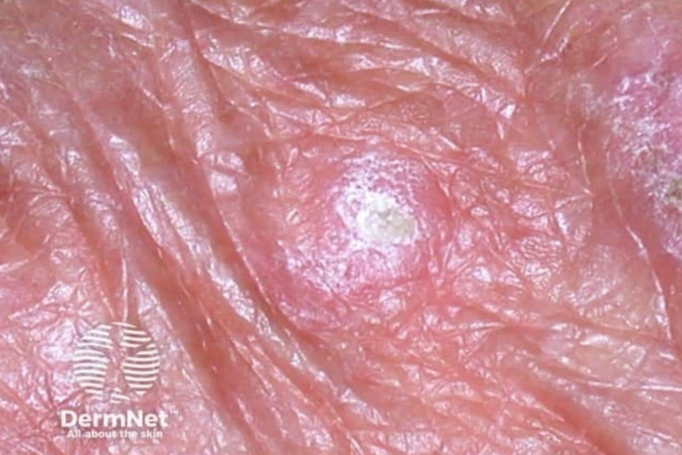 Close-up of solar keratosis (actinic keratosis) showing a small, raised, scaly lesion on pink skin.