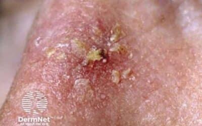 Actinic Keratosis vs Solar Keratosis: Is There a Difference?