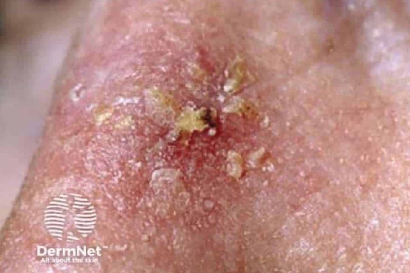 Close-up of solar keratosis (actinic keratosis) showing a red, scaly and crusted patch of sun-damaged skin.