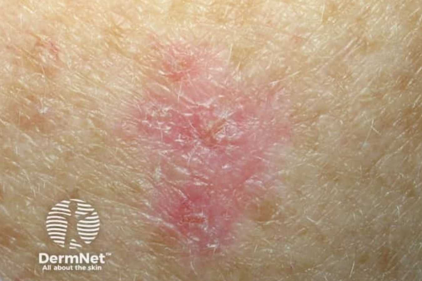 Superficial basal cell carcinoma appearing as a pink, scaly patch on the skin.